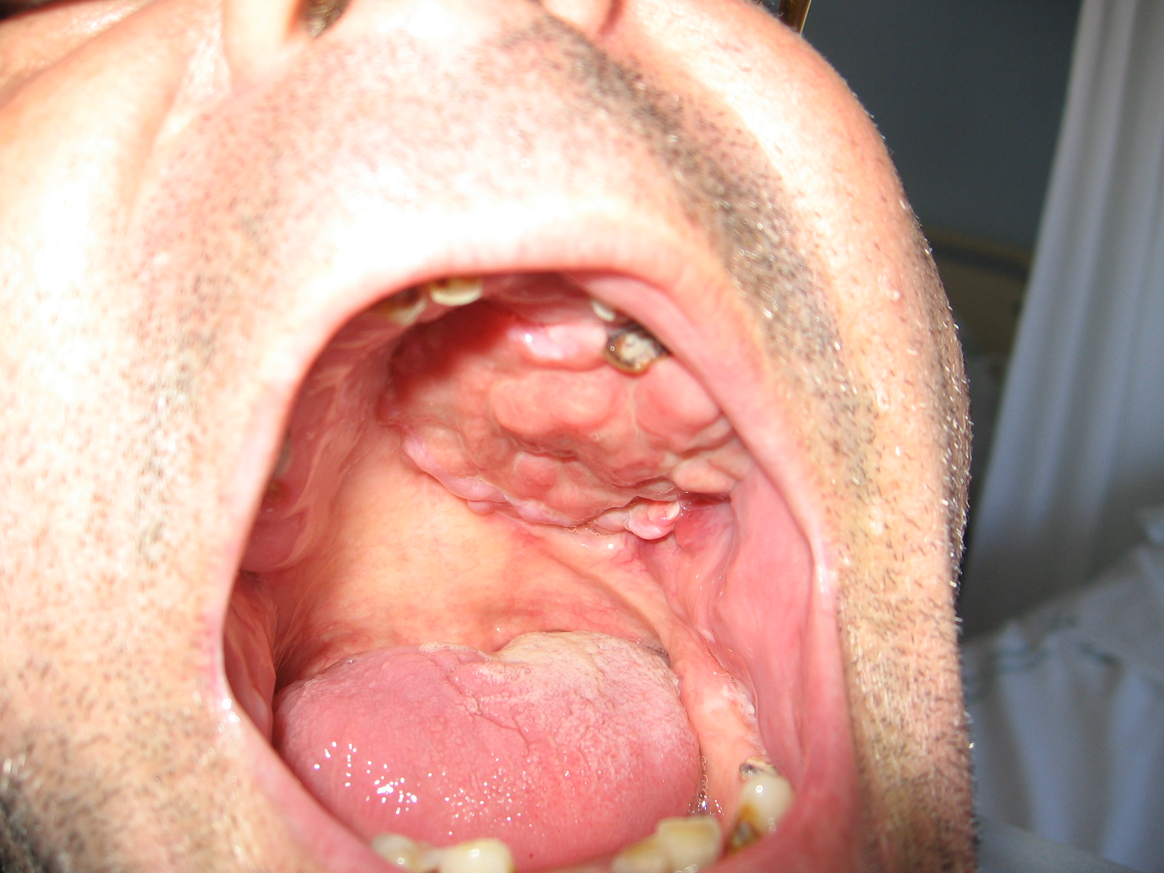 Linfoma plasmablástico. Cavidad oral